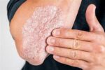 La psoriasis no es contagiosa
