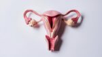 Un análisis genético a gran escala identifica regiones asociadas a la endometriosis Un análisis genético a gran escala identifica regiones asociadas a la endometriosis