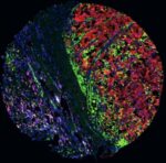 Una estrategia experimental reduce la metástasis del melanoma y mejora la inmunoterapia Una estrategia experimental reduce la metástasis del melanoma y mejora la inmunoterapia