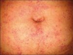 Salud pide no confundir la Rickettsia con dengue Salud pide no confundir la Rickettsia con dengue