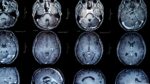 Un mapa celular para entender las enfermedades cerebrales Un mapa celular para entender las enfermedades cerebrales