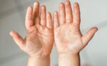 Pediátrico atiende entre 4 y 6 pacientes por semana por enfermedad de manos, pies, boca Pediátrico atiende entre 4 y 6 pacientes por semana por enfermedad de manos, pies, boca